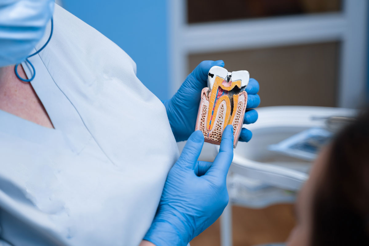 Modelo de diente con caries explicado por dentista